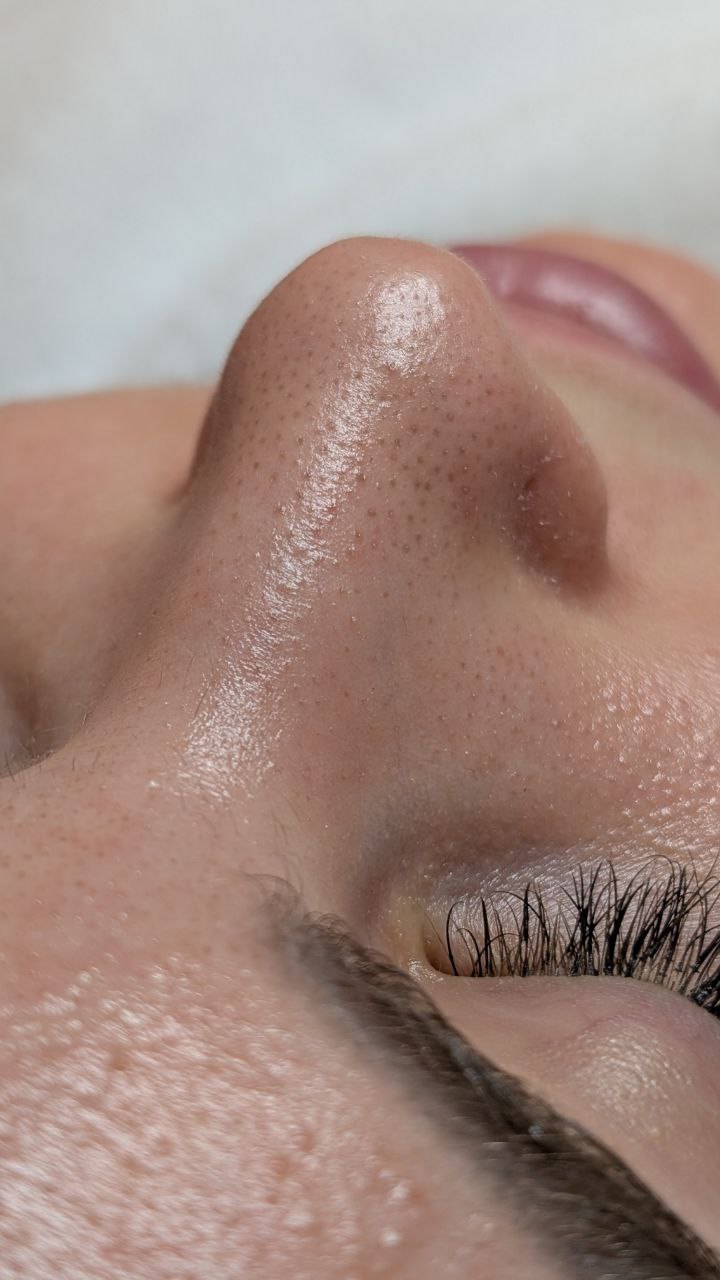 Vorher Microneedling Behandlung