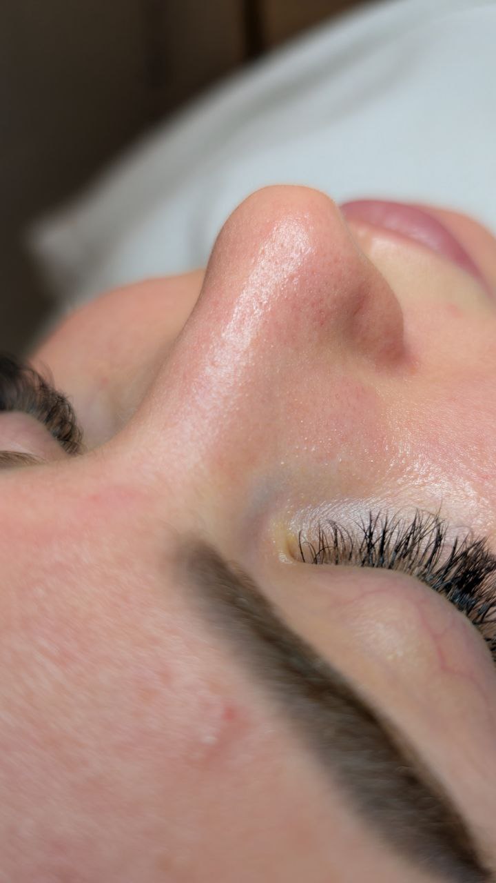 Nachher Microneedling Behandlung